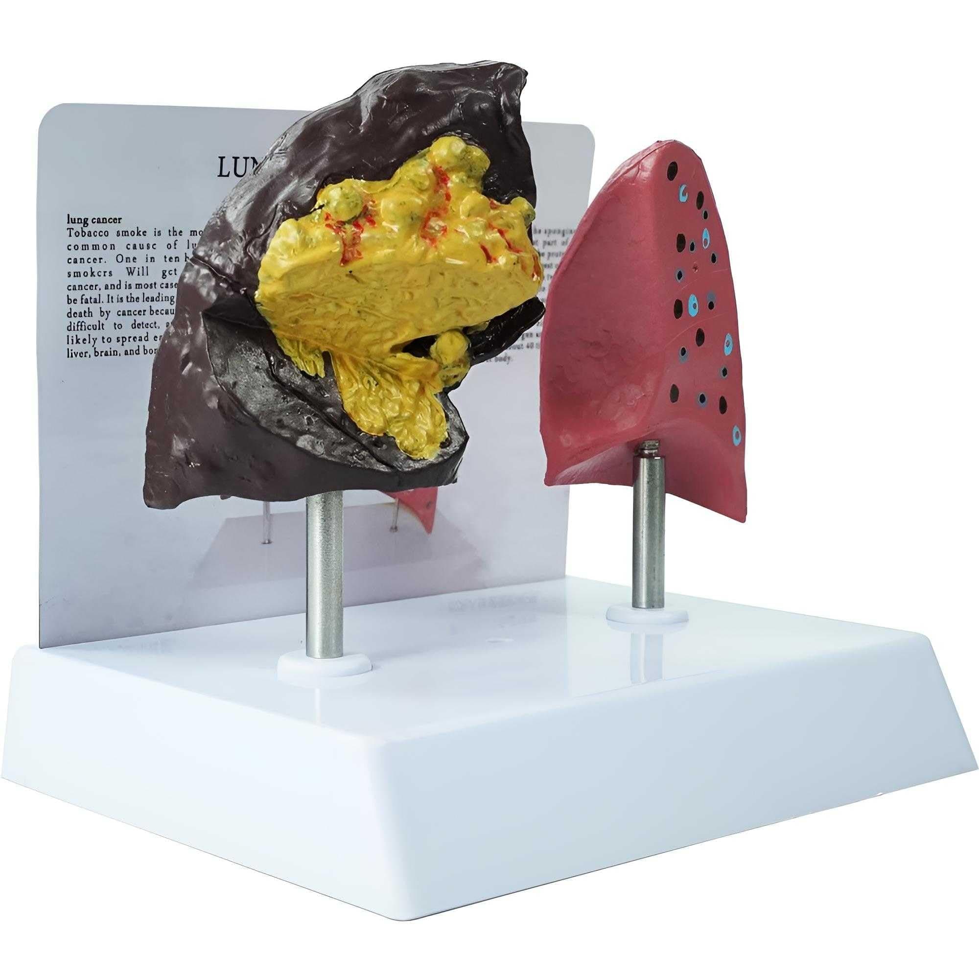 SKUWGW Smoker's Lung vs Healthy Lung Comparative Model - Life Size Anatomical Display for Medical Education, Respiratory Health Study Tool with Pathological Features, PVC Structure